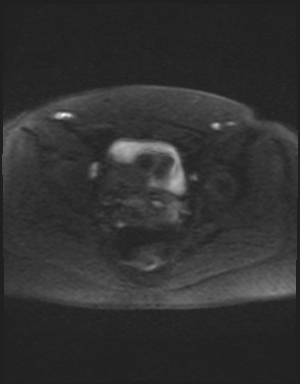 Class II Mullerian duct anomaly- unicornuate uterus with rudimentary horn and non-communicating cavity (Radiopaedia 39441-41755 Axial DWI 50).jpg