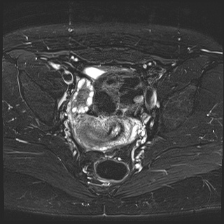 File:Class II Mullerian duct anomaly- unicornuate uterus with rudimentary horn and non-communicating cavity (Radiopaedia 39441-41755 Axial T2 fat sat 16).jpg