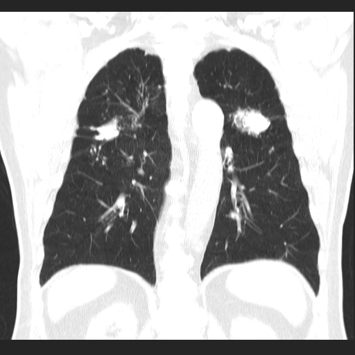 File:Classic complicated silicosis (Radiopaedia 49720-54961 Coronal lung window 42).jpg