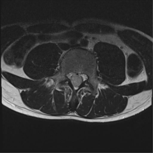 File:Clear cell meningoma - lumbar spine (Radiopaedia 60116-67690 Axial T2 16).png