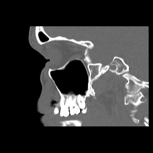 File:Cleft hard palate and alveolus (Radiopaedia 63180-71710 Sagittal bone window 19).jpg