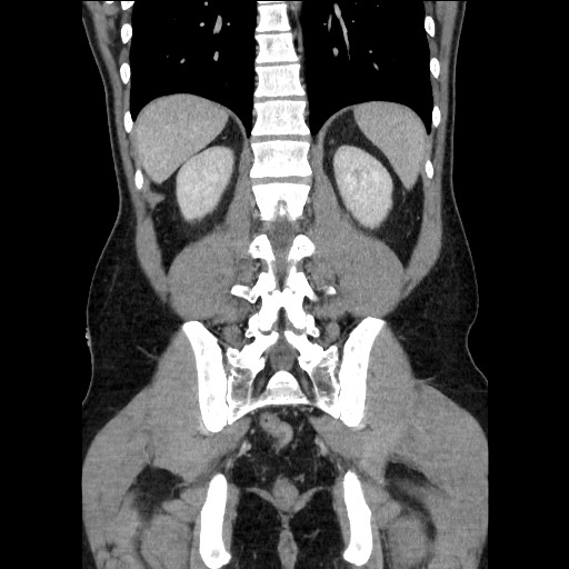 Closed-loop small bowel obstruction (Radiopaedia 73713-84509 C 92).jpg