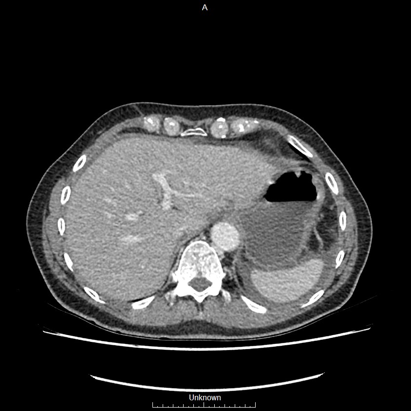 Closed loop bowel obstruction and ischemia (Radiopaedia 86959-103180 A 5).jpg