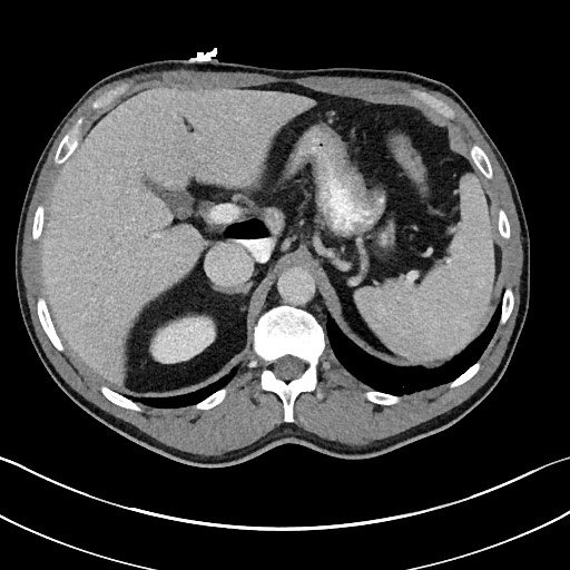 File:Closed loop small bowel obstruction - internal hernia (Radiopaedia 57806-64778 B 31).jpg