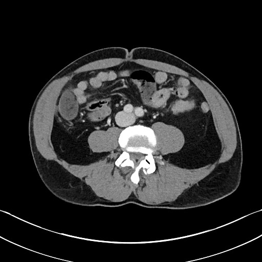 Closed loop small bowel obstruction - internal hernia (Radiopaedia 57806-64778 B 74).jpg