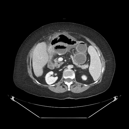 Closed loop small bowel obstruction - internal hernia (Radiopaedia 65402-74450 A 45).jpg