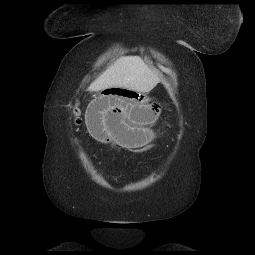 Closed loop small bowel obstruction - internal hernia (Radiopaedia 65402-74450 B 18).jpg