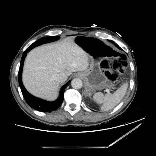 Closed loop small bowel obstruction - omental adhesion causing "internal hernia" (Radiopaedia 85129-100682 A 23).jpg