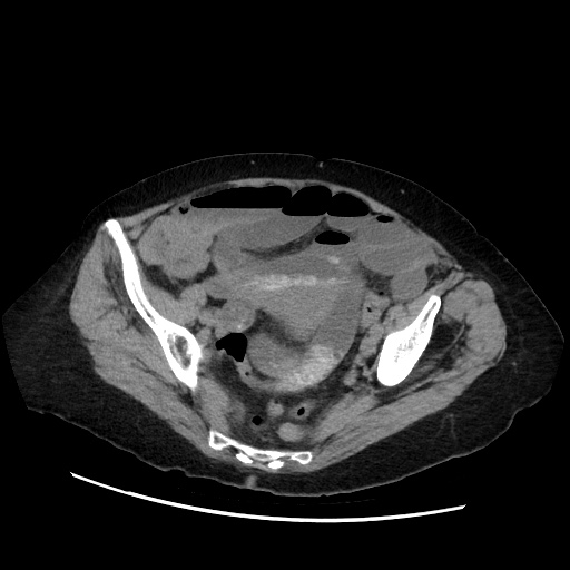 Closed loop small bowel obstruction due to adhesive band, with intramural hemorrhage and ischemia (Radiopaedia 83831-99017 Axial non-contrast 128).jpg