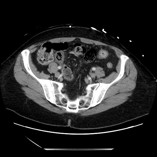 Closed loop small bowel obstruction due to adhesive bands - early and late images (Radiopaedia 83830-99014 A 114).jpg
