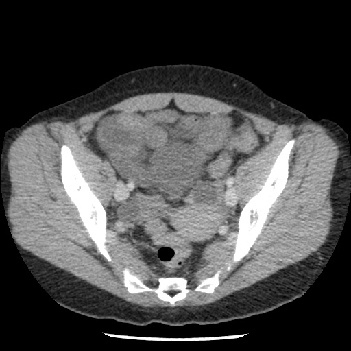 File:Closed loop small bowel obstruction due to trans-omental herniation (Radiopaedia 35593-37109 A 71).jpg