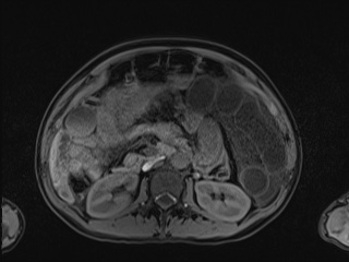 Closed loop small bowel obstruction in pregnancy (MRI) (Radiopaedia 87637-104031 Axial T1 fat sat 52).jpg