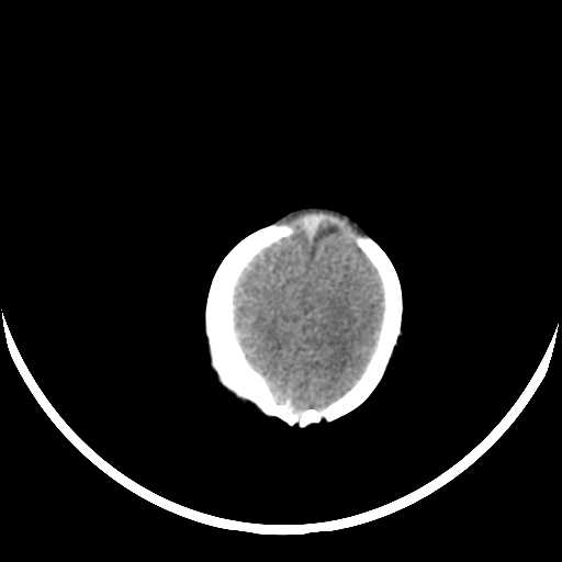 File:Cloverleaf shaped skull in the absence of craniosynostosis (Radiopaedia 21296-21216 Axial non-contrast 18).jpg