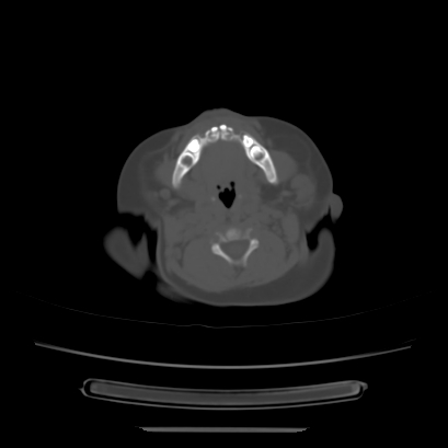 Cloverleaf skull (Radiopaedia 91901-109710 Axial bone window 26).jpg