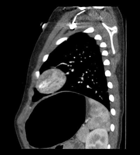 Coarctation of aorta (Radiopaedia 27427-27622 Sagittal C+ CTPA 113).png