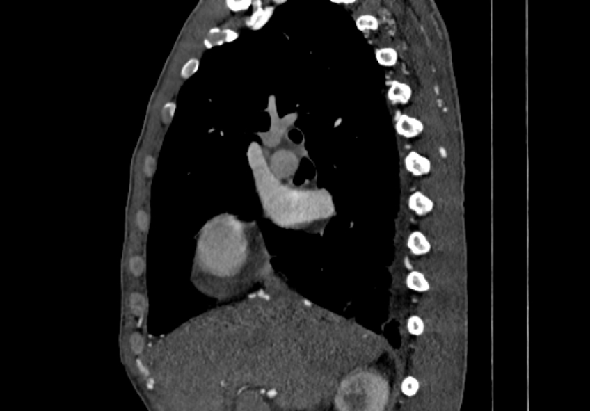Coarctation of aorta with aortic valve stenosis (Radiopaedia 70463-80574 B 1).jpg