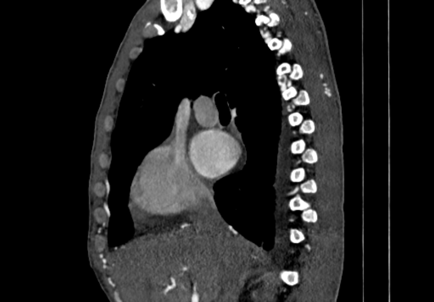 Coarctation of aorta with aortic valve stenosis (Radiopaedia 70463-80574 B 13).jpg