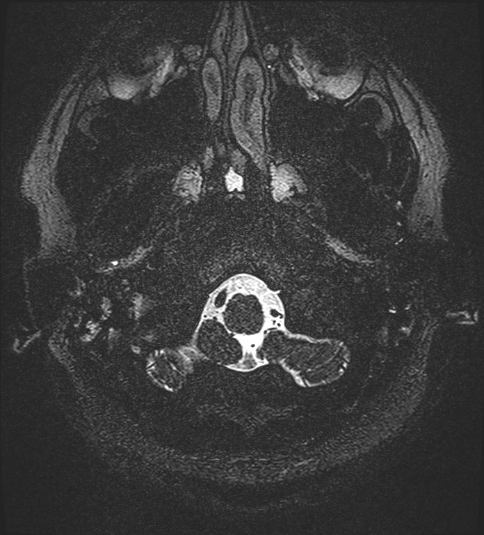 Cochlear incomplete partition type III associated with hypothalamic hamartoma (Radiopaedia 88756-105498 Axial T2 12).jpg