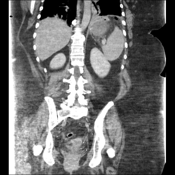 File:Collection due to leak after sleeve gastrectomy (Radiopaedia 55504-61972 B 33).jpg