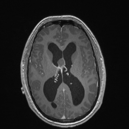 File:Colloid cyst (Radiopaedia 44510-48181 Axial T1 C+ 102).png