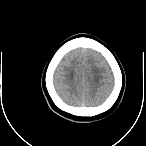 Colloid cyst (Radiopaedia 52865-58792 Axial non-contrast 17).jpg