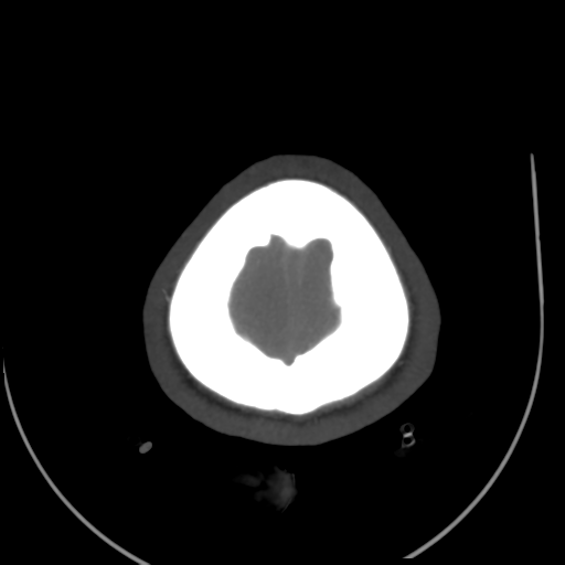 File:Colloid cyst (resulting in death) (Radiopaedia 33423-34499 A 55).png
