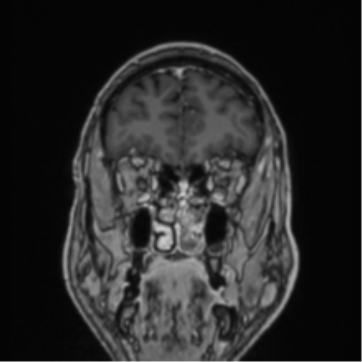 File:Colloid cyst of the third ventricle (Radiopaedia 86571-102662 Coronal T1 C+ 75).png