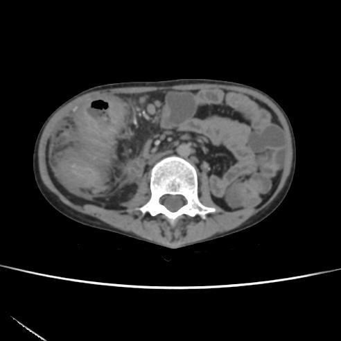 File:Colocolic fistula - Crohn disease (Radiopaedia 57063-63955 A 40).jpg