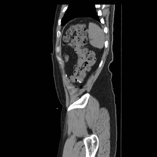 Colocutaneous fistula in Crohn's disease (Radiopaedia 29586-30093 F 51).jpg