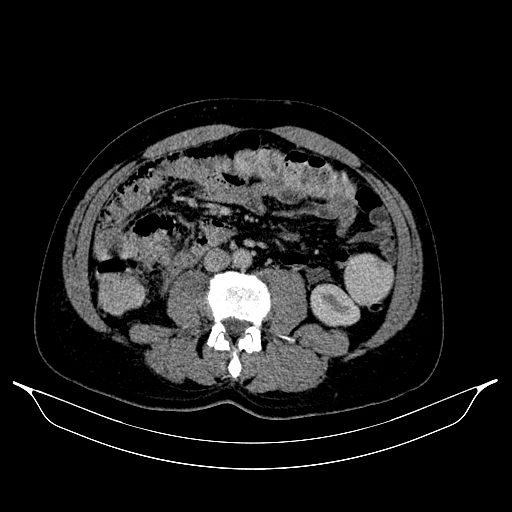 Colonic diverticulosis (Radiopaedia 72222-82744 A 24).jpg