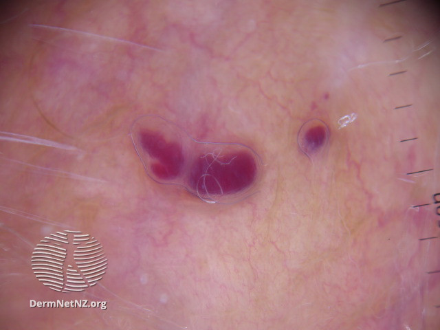 File:Dermoscopy of angiokeratoma of Fordyce on vulva (DermNet NZ angiokeratoma-53).jpg