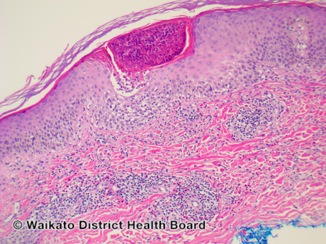 File:Figure 2 (DermNet NZ pathology-w-eosinophilic-folliculitis-fig-2).jpg