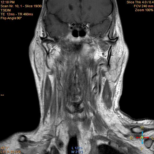 File:Nasopharyngeal carcinoma (Radiopaedia 22375-22403 Coronal T1 C+ 8).jpg