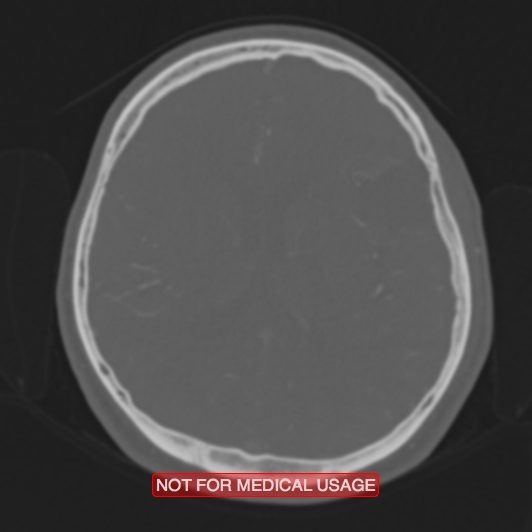 Nasopharyngeal carcinoma recurrence - skull base destruction (Radiopaedia 29107-29490 Axial bone window 44).jpg
