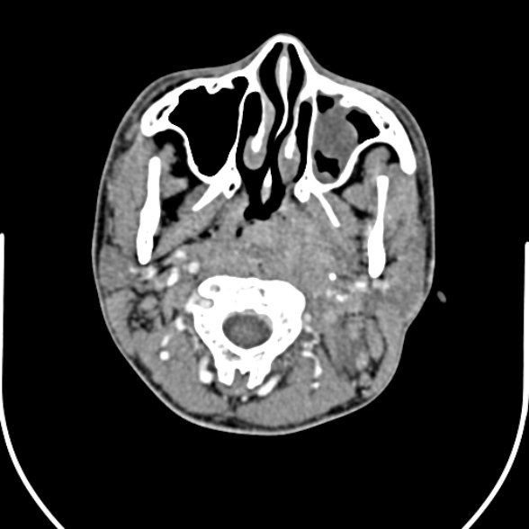 Nasopharyngeal carcinoma with skull base invasion (Radiopaedia 53415-59705 A 62).jpg