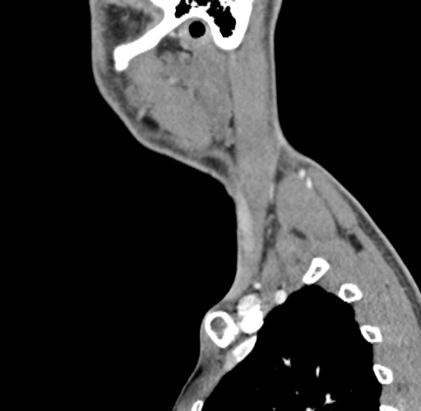 Nasopharyngeal carcinoma with skull base invasion (Radiopaedia 53415-59705 C 7).jpg