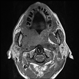 Nasopharyngeal carcinoma with skull base invasion (Radiopaedia 59258-66600 B 28).jpg