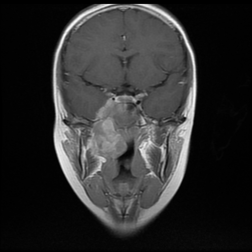 File:Nasopharyngeal rhabdomyosarcoma (Radiopaedia 23417-23486 Coronal T1 C+ 8).jpg