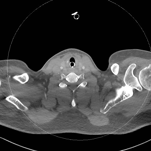 Neck CT angiogram (intraosseous vascular access) (Radiopaedia 55481-61945 B 142).jpg