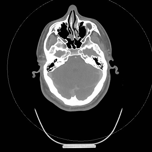 Neck CT angiogram (intraosseous vascular access) (Radiopaedia 55481-61945 B 276).jpg
