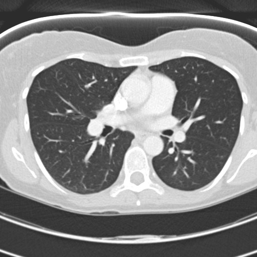 Necrobiotic pulmonary nodules - Crohn disease (Radiopaedia 20723-20631 Axial lung window 67).jpg
