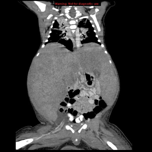 File:Neonatal neuroblastoma (Radiopaedia 9564-10223 B 75).jpg