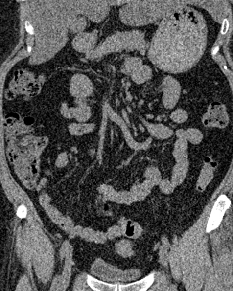 File:Nephrostomy for urosepsis (Radiopaedia 26180-26330 non-contrast 37).jpg