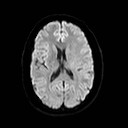 File:Neuro-Behcet's disease (Radiopaedia 21557-21506 Axial DWI 16).jpg