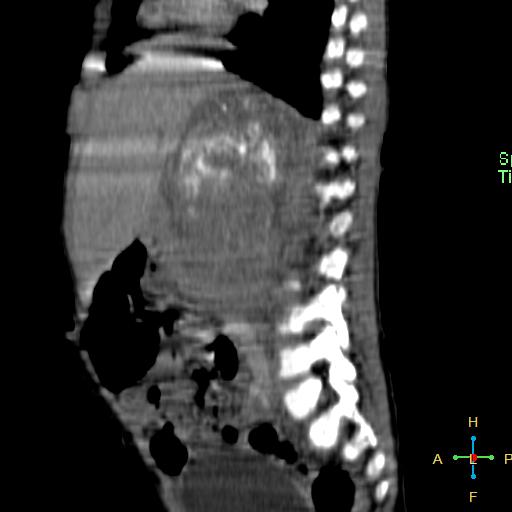 File:Neuroblastoma (Radiopaedia 24751-25016 C 17).jpg