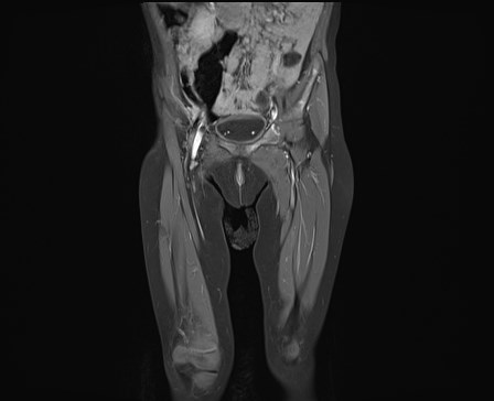 File:Neuroblastoma with bone metastases (Radiopaedia 67080-76414 E 7).jpg