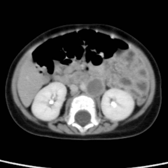 Neuroblastoma with skull metastases (Radiopaedia 30326-30960 C 31).jpg