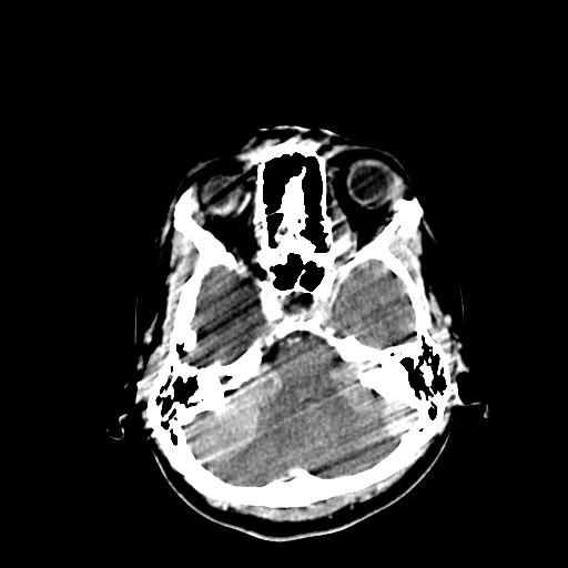 File:Neurofibromatosis type 2 (Radiopaedia 25389-25637 Axial C+ 17).jpg