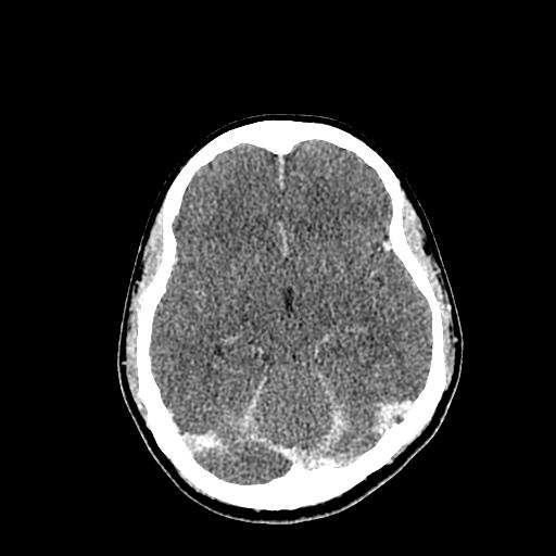 File:Neurofibromatosis type 2 (Radiopaedia 25389-25637 Axial C+ 42).jpg