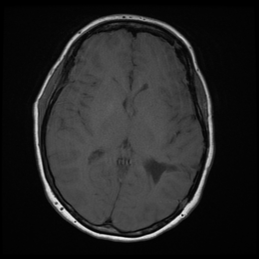 File:Neurofibromatosis type 2 (Radiopaedia 45229-49247 Axial T1 12).png